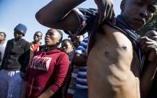 Tembisa resident Mduduzi Mahlangu shows a rubber bullet wound inflicted by the Ekurhuleni Metro Police during a demolition operation where hundreds of illegal shacks were destroyed. Picture: Reinart Toerien/EWN.