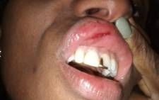 Duduzile Zuma's injuries after she was attacked by coworker Maflas Tshota. Picture: Supplied