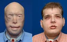 This combination photo provided 16 November, 2015 by the NYU Langone Medical Center shows face transplant patient Patrick Hardison before(L) and after his surgery. Picture: AFP.