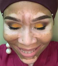 Understanding vitiligo: 'It is not infectious or life-threatening' says expert