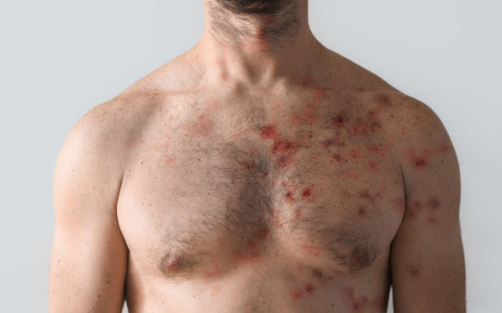 FILE: A man with a blistering monkeypox rash. Picture: © halfpoint/123rf.com