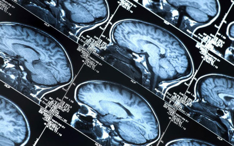 Brain implant offers Parkinson's hope