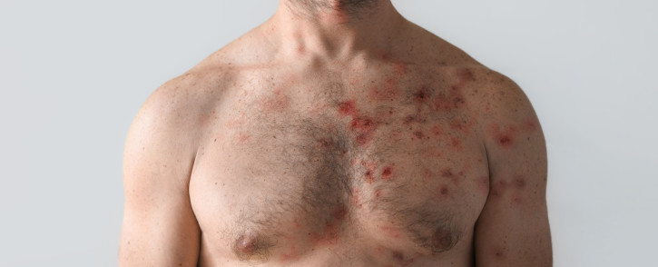 FILE: A man with a blistering monkeypox rash. Picture: © halfpoint/123rf.com