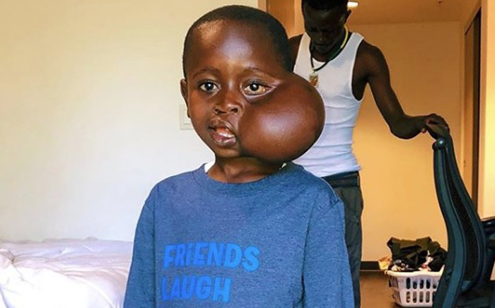DRC boy who travelled to LA to remove face tumour dies